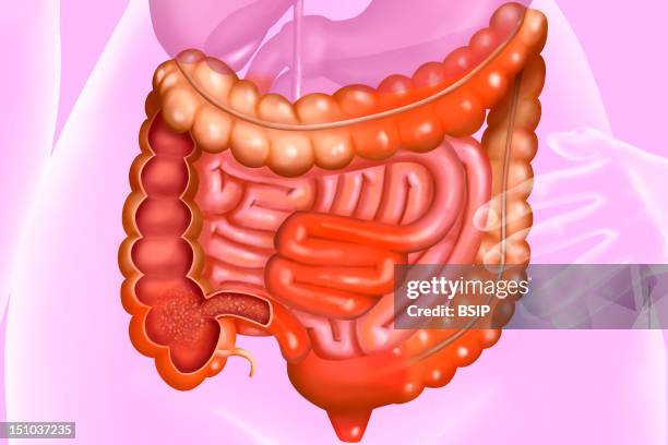 CrohnS Disease. CrohnS Disease Is A Chronic Inflammation Of The Digestive Tube, Affecting Mainly The Ileon, The Colon And The Anus. CrohnS Disease...