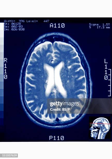 Axial Section Of A Human Skull Visualized By Mri.