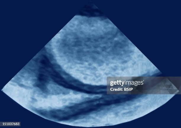 Pericardial Effusion Caused By A Rupture Of The Aorta Cardiac Transversale Transesophageal Echography.