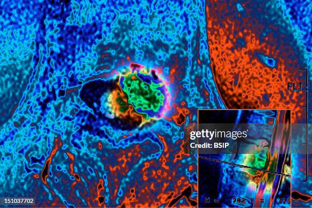 Compression Of The Medulla Due To Malignant Tumor. Mri Of Lumbar Vertebrae.