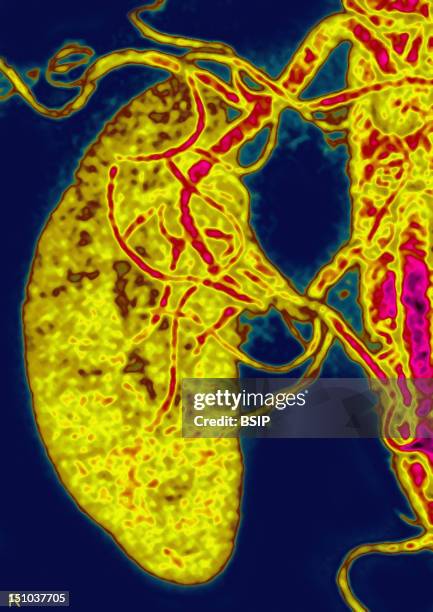 Normal Right Kidney, Visualized By Angiography Scanner In 3D Reconstruction.