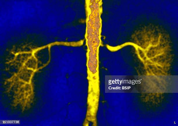 Stenosis Of The Left Renal Artery And Plaque Of Atheroma Abdominal Angiography.