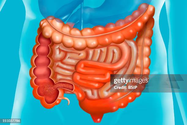 CrohnS Disease. CrohnS Disease Is A Chronic Inflammation Of The Digestive Tube, Affecting Mainly The Ileon, The Colon And The Anus. CrohnS Disease...