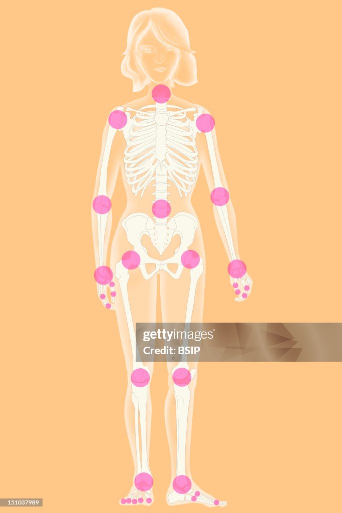 Osteoarthritis, Illustration