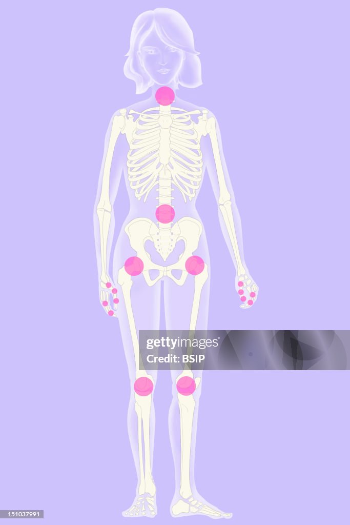 Osteoarthritis, Illustration