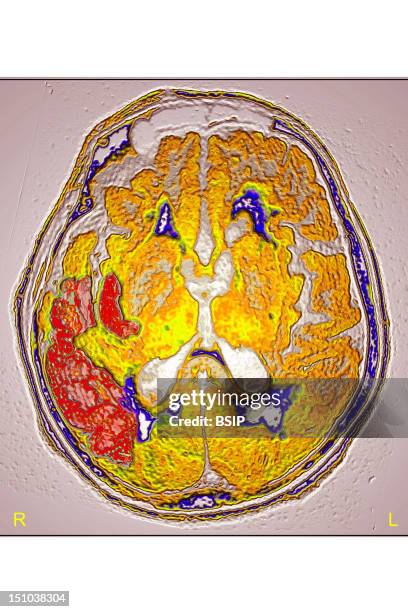 Stroke Due To Arterial Thrombosis In Right Hemisphere. Ct Scan Of Brain, Axial View.