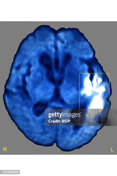 Stroke Due To Arterial Thrombosis In Left Hemisphere. Ct Scan Of Brain, Axial View.