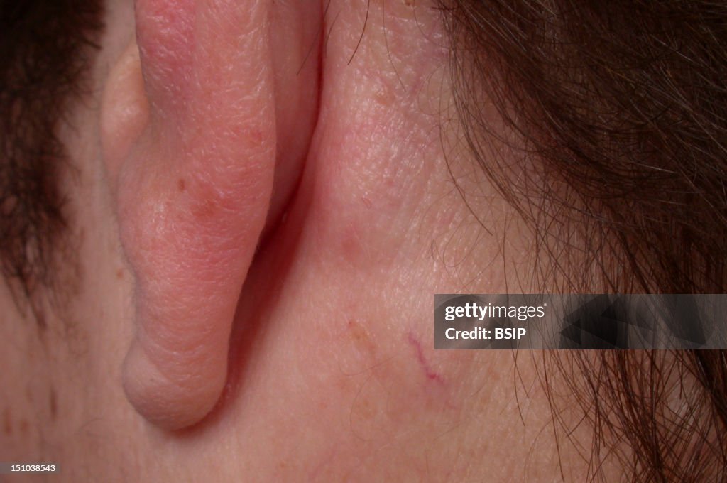 Lipoma