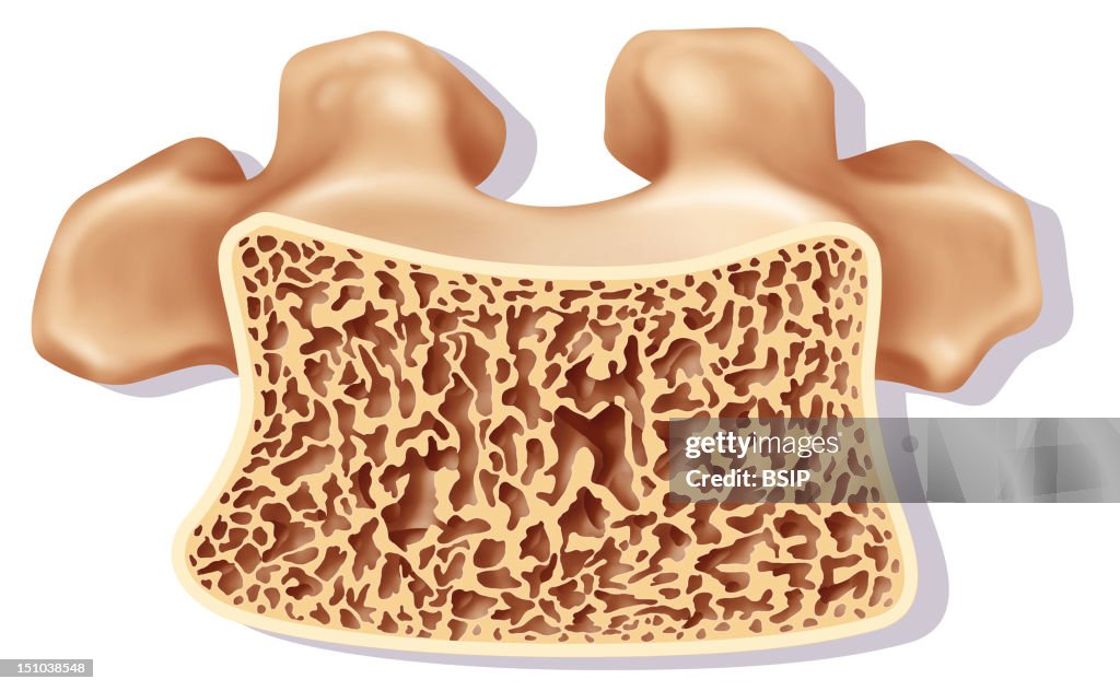 Osteoporosis, Illustration