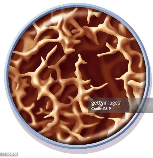 Stucture Of The Bone Affected By Osteoporosis Spongy Cancellous Bone. A Bone Is Composed Of Compact Tissue At The Periphery And Of Spongious Tissue...