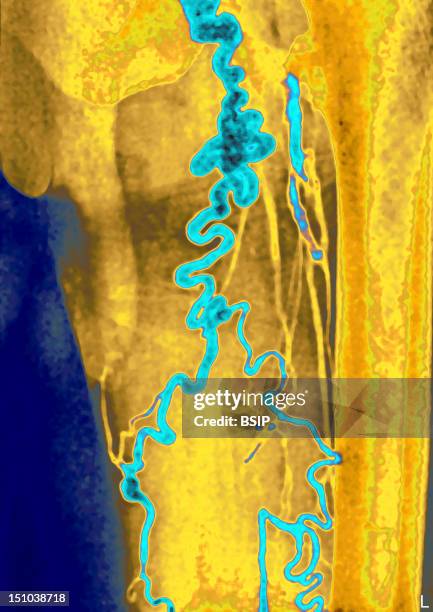 Varicose Veins Of The Left Thigh Phlebography Of The Leg In Front View.