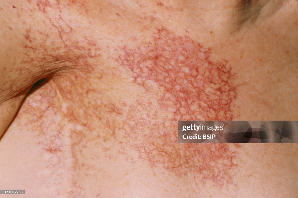 Radiodermatitis On Mastectomy News Photo Getty Images radiodermatitis-on-mastectomy-news-photo-getty-images