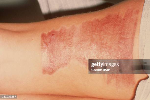 Radiodermatitis