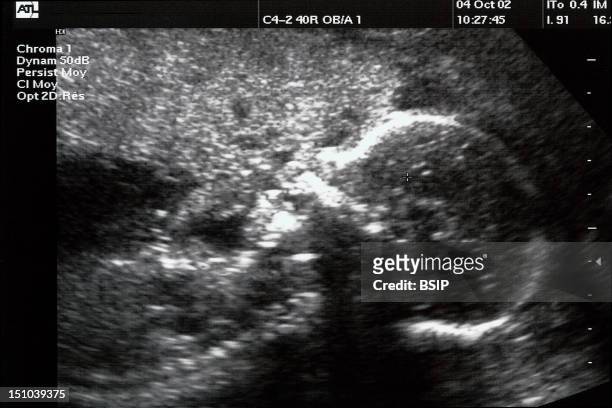 Sagittal View. Open Mouth Is Visible. 22 Week Old Fetus.