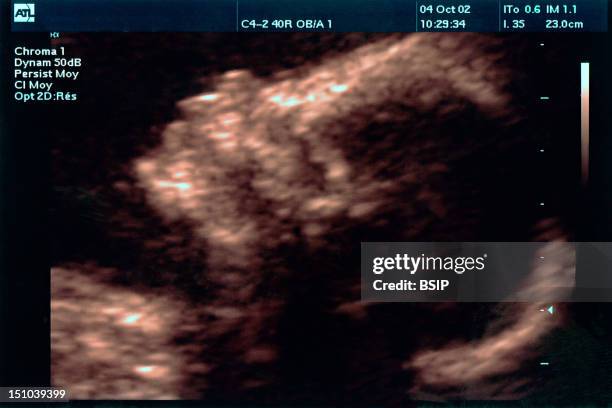 Sagittal View. 22 Week Old Fetus.