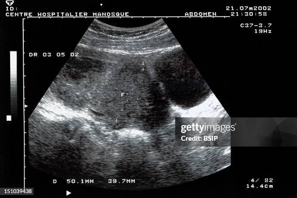 Uterine Fibroma, Sonography