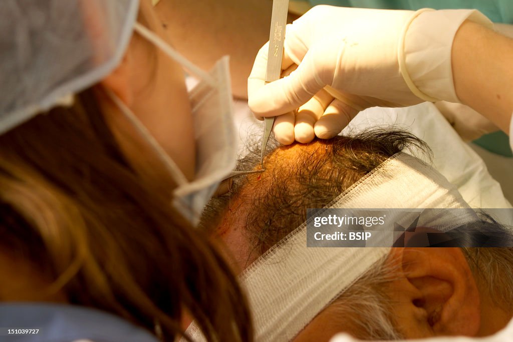 Implant Hair Surgery