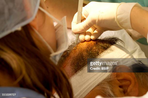 Private Dermatology Practice. Hair Transplant. Implantation.