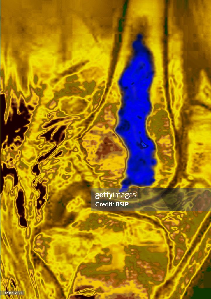 Osteonecrosis Of The Knee Rmn