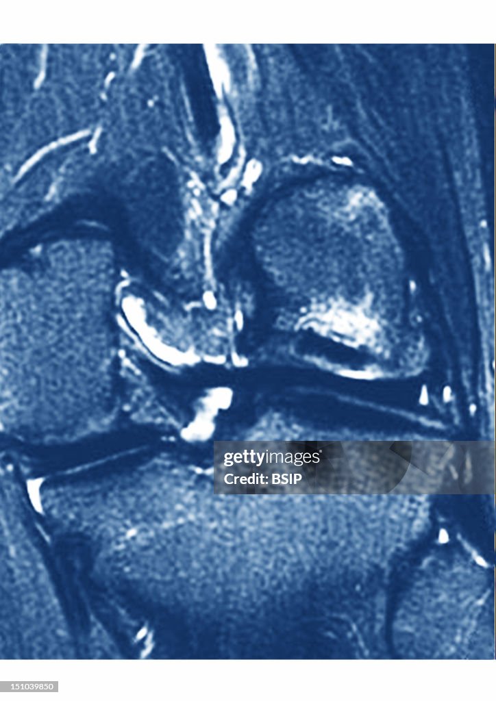 Exostosis, Mri