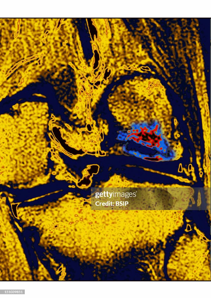 Exostosis, Mri