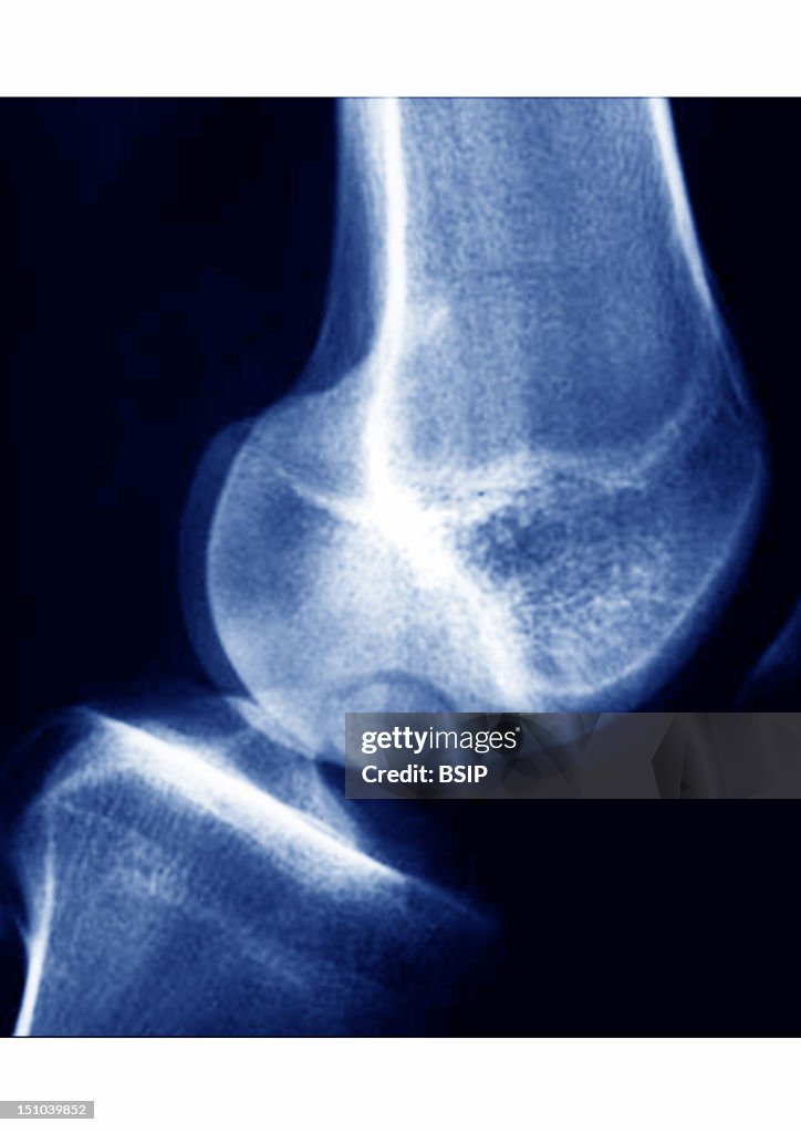 Exostosis, X-Ray