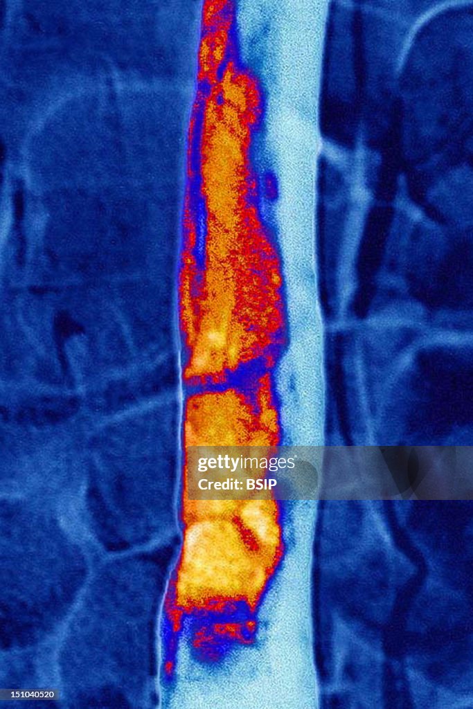 Aortic Thrombus, Angiographiy