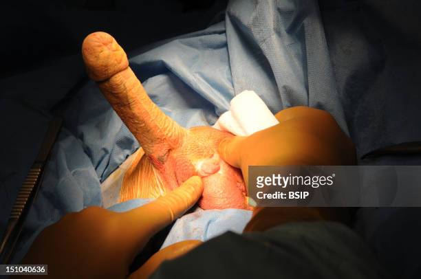 Photo Essay At Lyon Hospital. Department Of Urology. Phalloplastie, Operation Of Plastic Surgery To Create A Phallus, Required To Complete A Change...