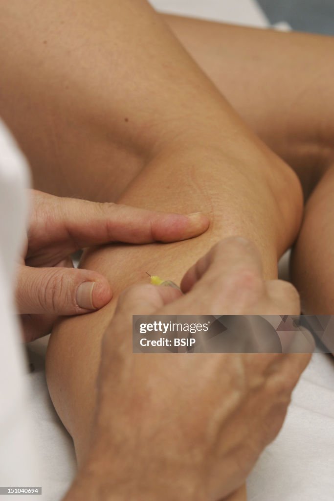 Varicose Vein Sclerotherapy