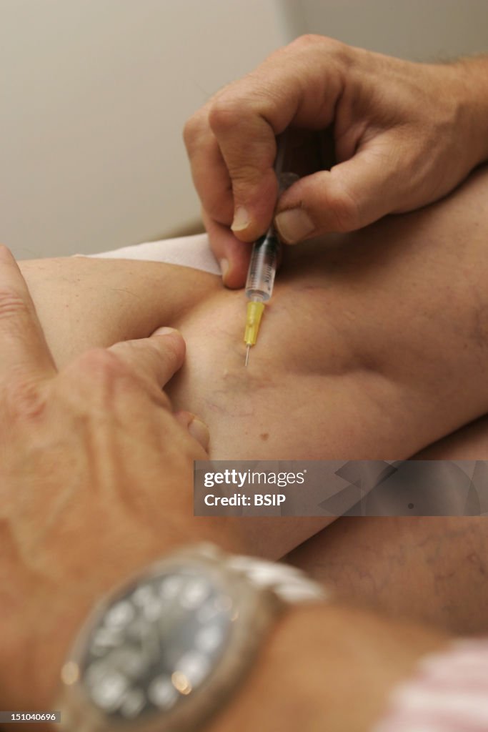 Varicose Vein Sclerotherapy