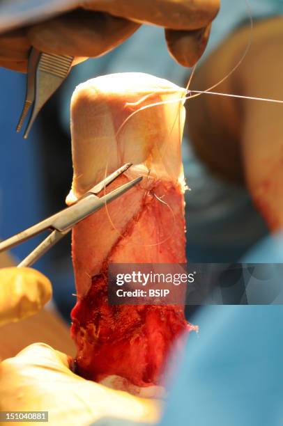 Photo Essay At Lyon Hospital, France. Department Of Urology. Vaginoplasty, Operation Of Plastic Surgery To Create A Vagina, Required To Complete A...