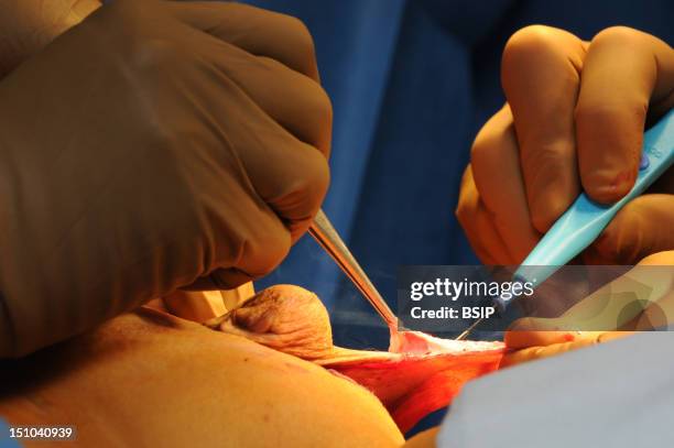 Photo Essay At Lyon Hospital, France. Department Of Urology. Vaginoplasty, Operation Of Plastic Surgery To Create A Vagina, Required To Complete A...