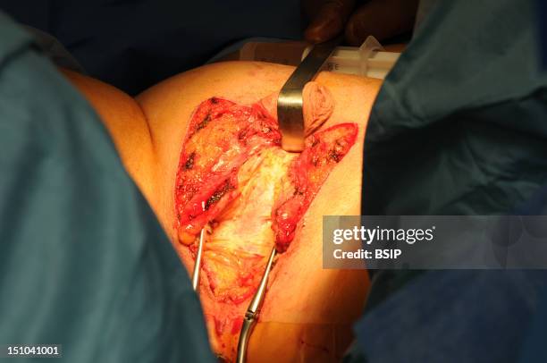 Photo Essay At Lyon Hospital, France. Department Of Urology. Vaginoplasty, Operation Of Plastic Surgery To Create A Vagina, Required To Complete A...