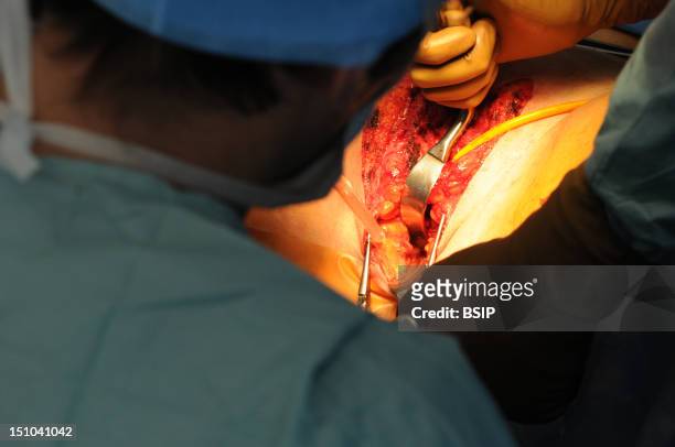 Photo Essay At Lyon Hospital, France. Department Of Urology. Vaginoplasty, Operation Of Plastic Surgery To Create A Vagina, Required To Complete A...