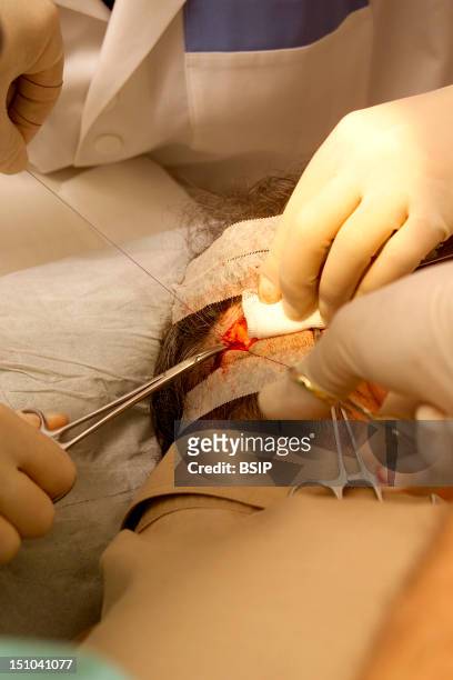 Private Dermatology Practice. Hair Transplant. Stitching After Removing The Donor Strip.