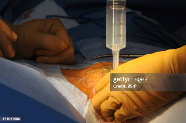 Meta Bottom Surgery Photo Essay At Lyon Hospital. Department Of Urology. Metoidioplasty ...