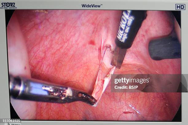 Photo Essay At Lyon Hospital, France. Department Of Urology. Sex Reassignment Sugery Transgender Ftm. Here Hystero Ovariectomy Under Laparoscopy....