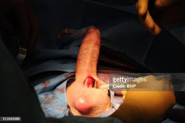 Photo Essay At Lyon Hospital. Department Of Urology. Surgical Treatment Of Erectile Dysfunction With A Penile Prosthesis. Test Of Erection With...