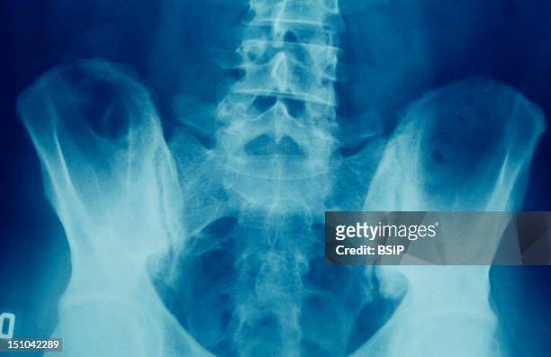 Ray Of The Sacroiliac Joint Revealing Inflammation.
