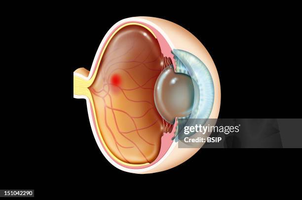 The Age Related Macular Degeneration Amd, Also Named Senile Macular Degeneration Is A Degenerative Disease Of The Macula Lutea, Central Area Of The...