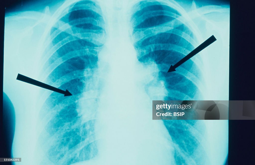 Sarcoidosis, X-Ray