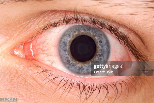 Conjunctivitis