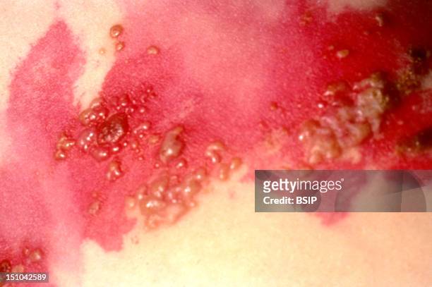 Intercostal Shingles Herpes Zoster.