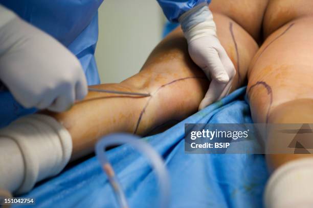 Photo Essay In Cosmetic Surgery. Liposuction. Aspiration Of The Fat Thanks To A Cannula It Is Linked To A Suction Pump.