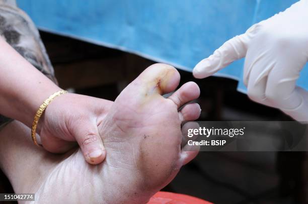 Independent Nurse, In Venissieux, France. Nursing Care At The Home Of A Patient Presenting A Diabetic Foot Ulcer.