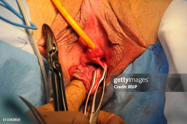 Photo Essay At Lyon Hospital, France. Department Of Urology. Sex Reassignment Sugery Transgender Ftm. Here Hystero Ovariectomy Under Laparoscopy....