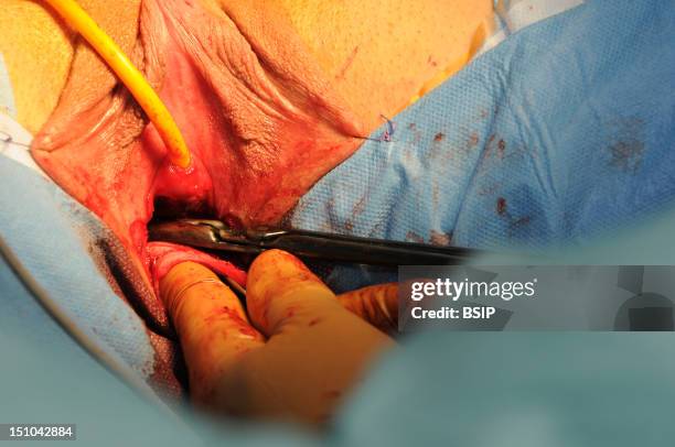 Photo Essay At Lyon Hospital, France. Department Of Urology. Sex Reassignment Sugery Transgender Ftm. Here Hystero Ovariectomy Under Laparoscopy....