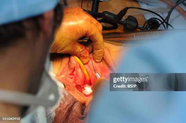 Photo Essay At Lyon Hospital, France. Department Of Urology. Sex Reassignment Sugery Transgender Ftm. Here Hystero Ovariectomy Under Laparoscopy....