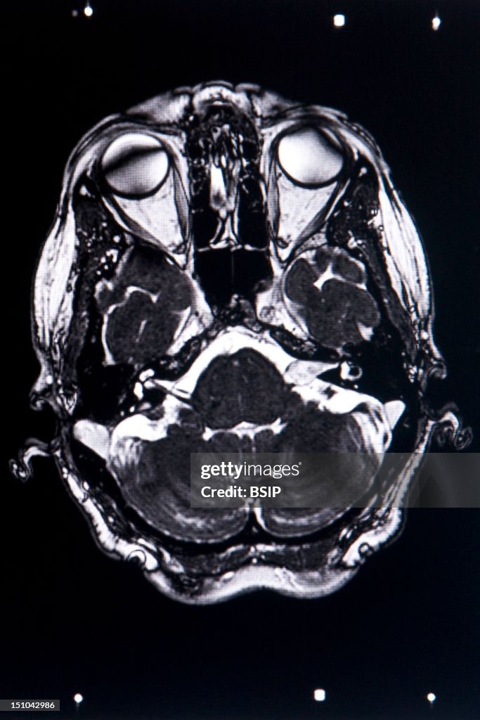Acoustic Neuroma, Mri