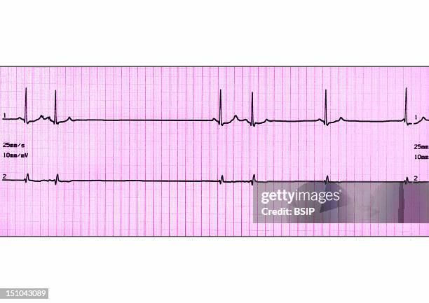 Irregular Pvc Irregular Ekg Photos and Premium High Res Pictures - Getty Images